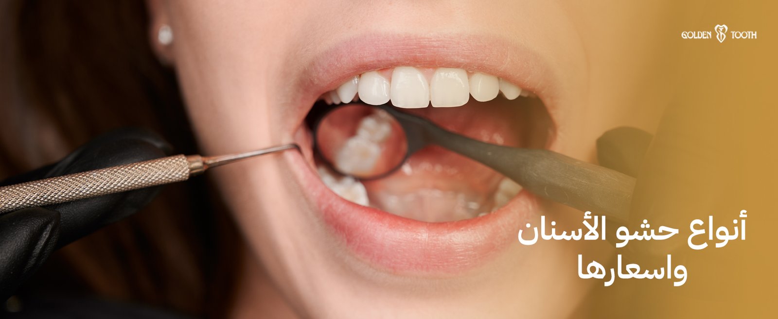 أنواع حشو الأسنان واسعارها وكل ما تحتاج معرفته