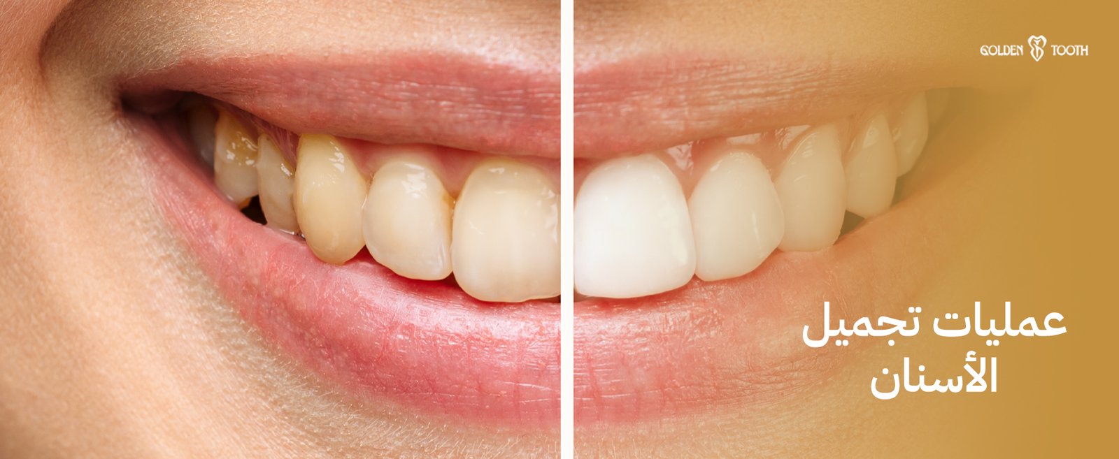 عمليات تجميل الأسنان